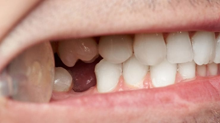 Woke up to a Teeth Falling out Dream? Here’s what you need to know